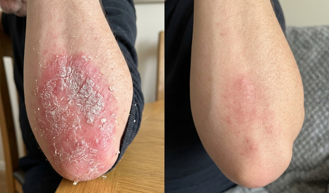 Sprej na psoriázu a šupinatú pokožku – Obrázok 2