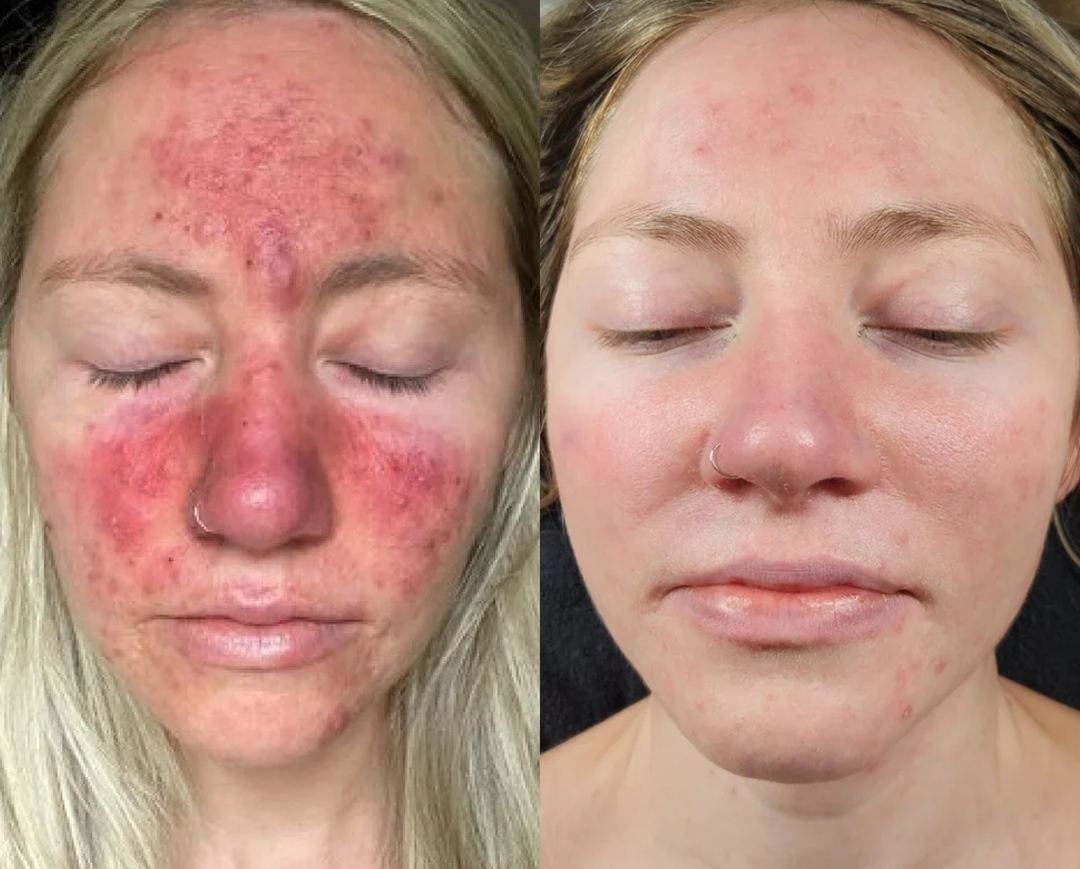 Sprej na psoriázu a šupinatú pokožku – Obrázok 4
